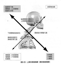 4DS カイロ引用　上部交差症候群　20161126163628957.jpg